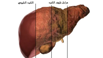 علامات تلف الكبد