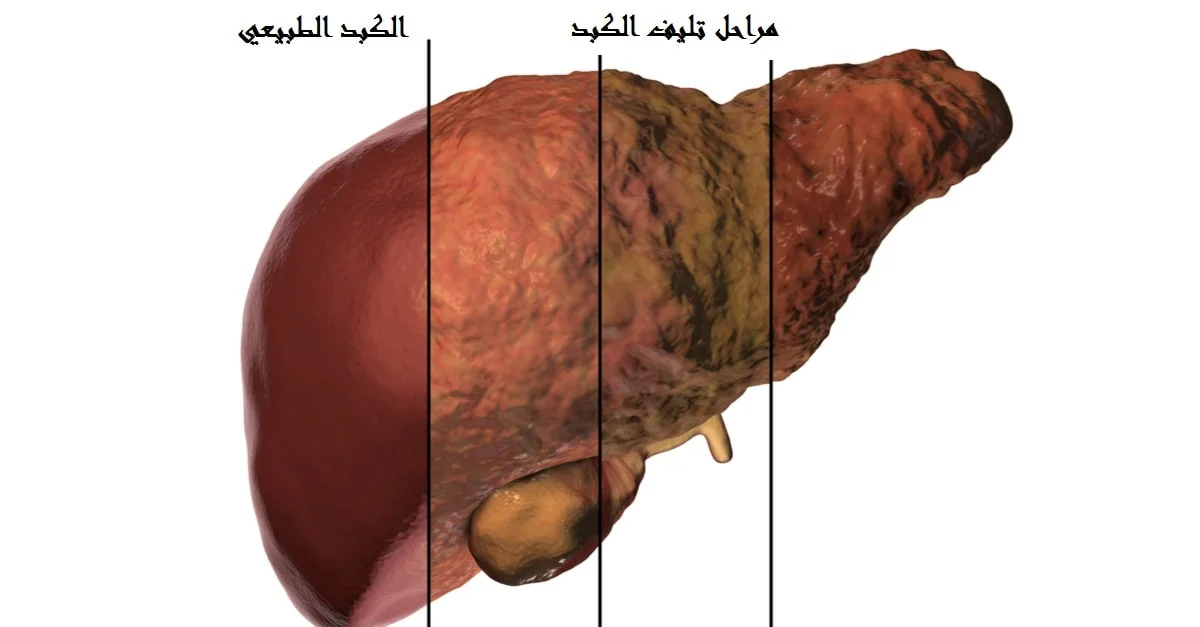 علامات تلف الكبد